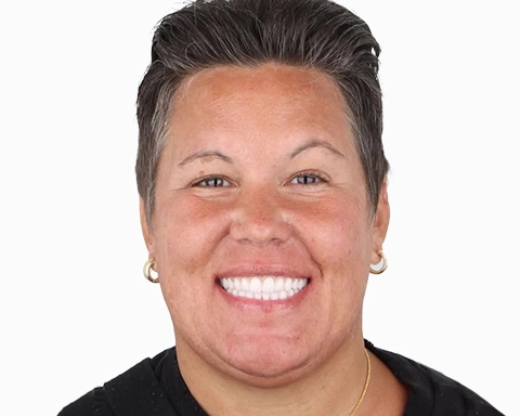 All-on-4 dental implants showcased in a Mexican dental clinic.