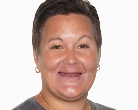 All-on-4 dental implants procedure and results in Mexico.