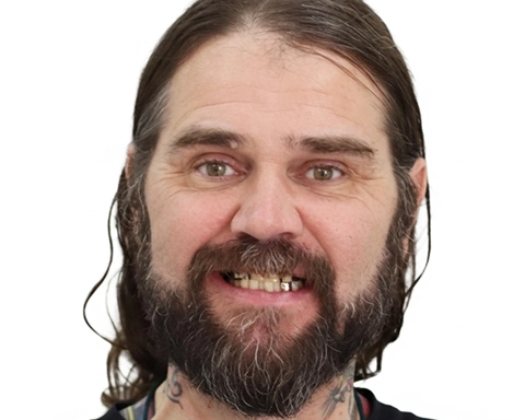 Final results of an All-on-4 dental implant treatment done in Mexico