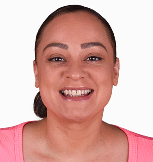 Visual results of cosmetic dental treatments, highlighting changes in a patient’s smile in Puerto Vallarta