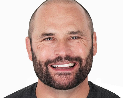 veneers application process in Puerto Vallarta.