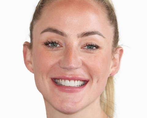 Before and after comparison of veneer treatment in Puerto Vallarta.