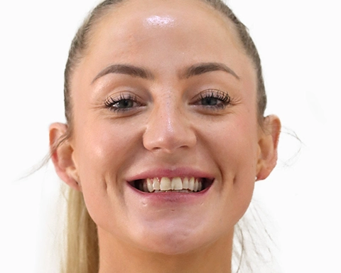 Before and after comparison of veneer treatment in Puerto Vallarta.