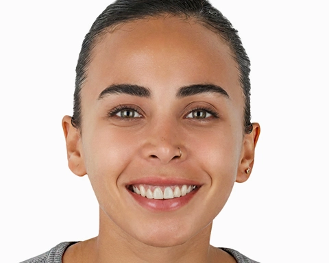 Before and after comparison of veneer treatment in Puerto Vallarta.