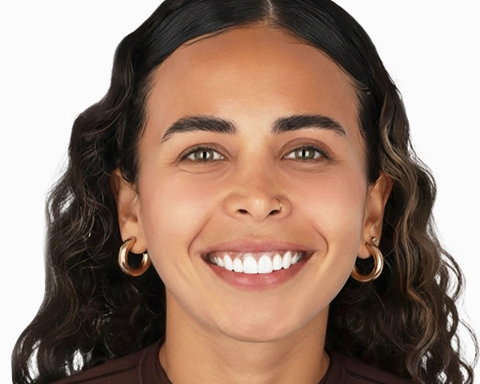 Before and after comparison of veneer treatment in Puerto Vallarta.