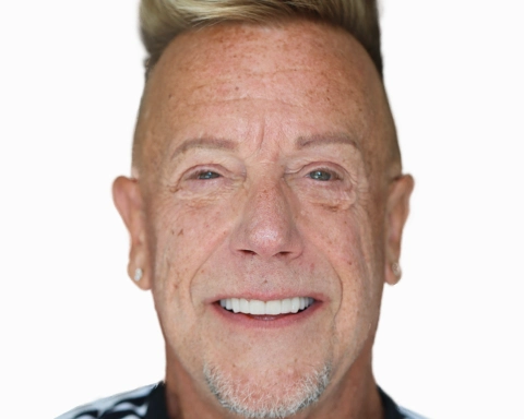 Before and after comparison of veneer treatment in Puerto Vallarta.